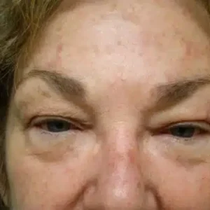 Eyelid Surgery before and after photos