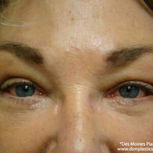 Eyelid Surgery before and after photos