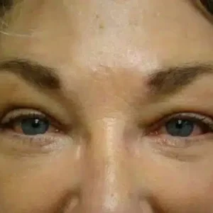 Eyelid Surgery before and after photos