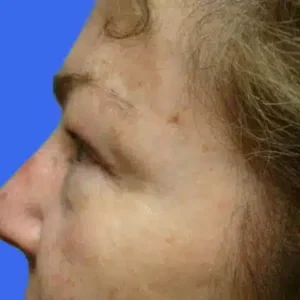 Eyelid Surgery before and after photos