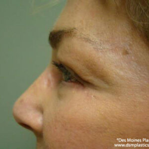 Eyelid Surgery before and after photos