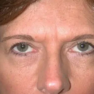 Brow Lift before and after photos