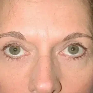 Brow Lift before and after photos