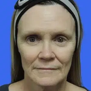 Laser Skin Resurfacing before and after photos