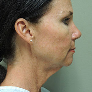 Laser Lift before and after photos