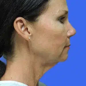 Laser Lift before and after photos