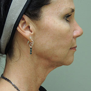 Laser Lift before and after photos