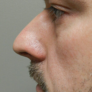 Rhinoplasty before and after photos