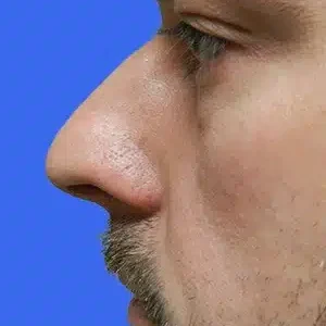 Rhinoplasty before and after photos