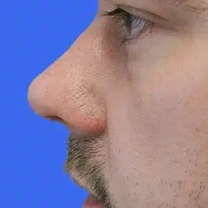 Rhinoplasty before and after photos