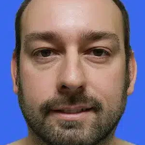 Rhinoplasty before and after photos