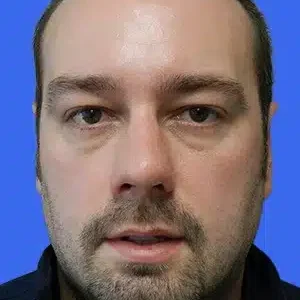 Rhinoplasty before and after photos