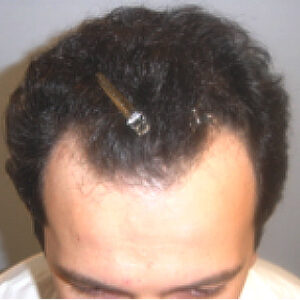 Neograft Hair Loss Replacement before and after photos