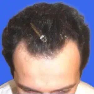 Neograft Hair Loss Replacement before and after photos