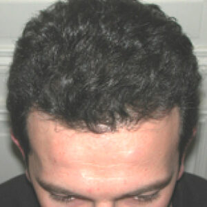 Neograft Hair Loss Replacement before and after photos