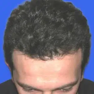 Neograft Hair Loss Replacement before and after photos