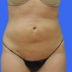 Liposuction before and after photos Liposuction before and after photos