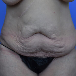 Tummy Tuck before and after photos
