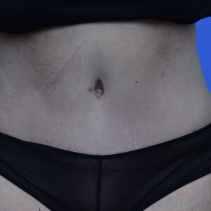 Tummy Tuck before and after photos