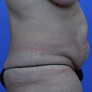 Tummy Tuck before and after photos