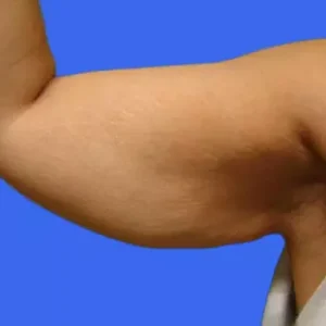 Arm Lift