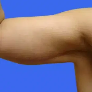Arm Lift