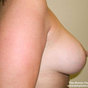 Breast Lift with Augmentation before and after photos
