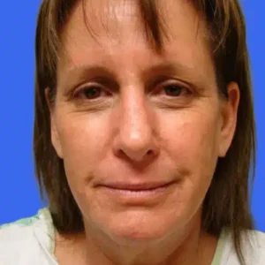 Face Lift before and after photos