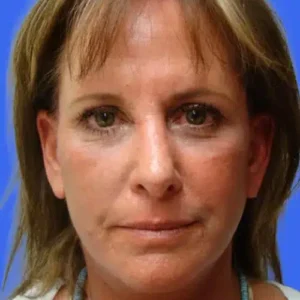 Face Lift before and after photos