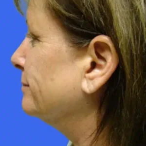 Face Lift before and after photos