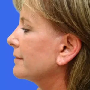 Face Lift before and after photos