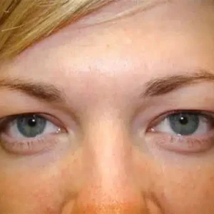 Eyelid Surgery before and after photos
