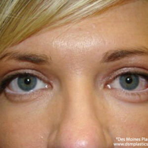 Eyelid Surgery before and after photos