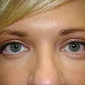 Eyelid Surgery before and after photos