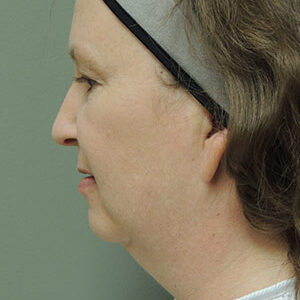 Laser Lift before and after photos