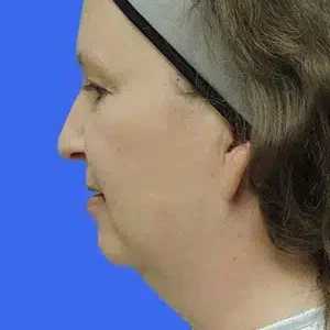 Laser Lift before and after photos