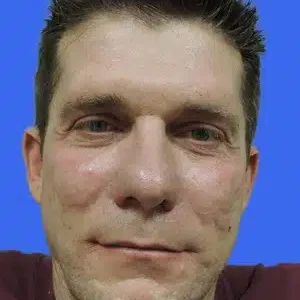 Laser Skin Resurfacing before and after photos