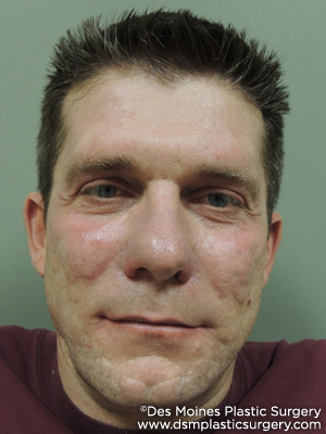 Laser Skin Resurfacing before and after photos