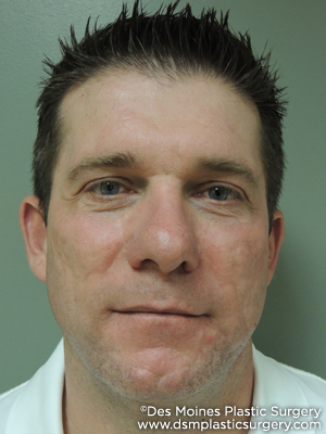 Laser Skin Resurfacing before and after photos
