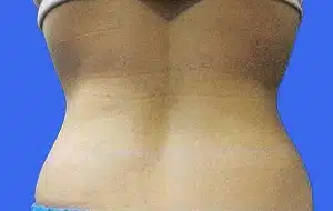 CoolSculpting before and after photos CoolSculpting before and after photos