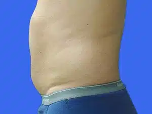 Liposuction before and after photos Liposuction before and after photos