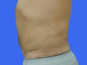 Liposuction before and after photos Liposuction before and after photos