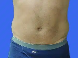 Liposuction before and after photos Liposuction before and after photos