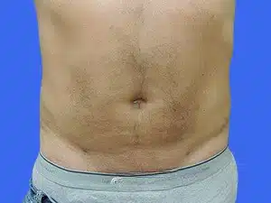 Liposuction before and after photos Liposuction before and after photos