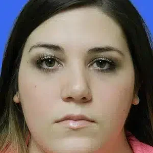 Rhinoplasty before and after photos