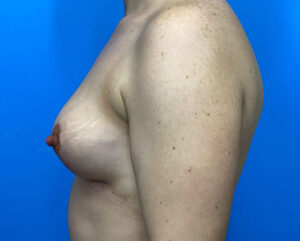 Breast Lift