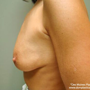 Breast Lift with Augmentation before and after photos