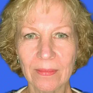 Face Lift before and after photos