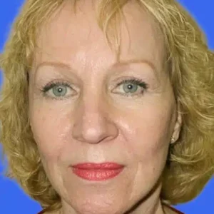 Face Lift before and after photos