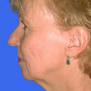 Face Lift before and after photos